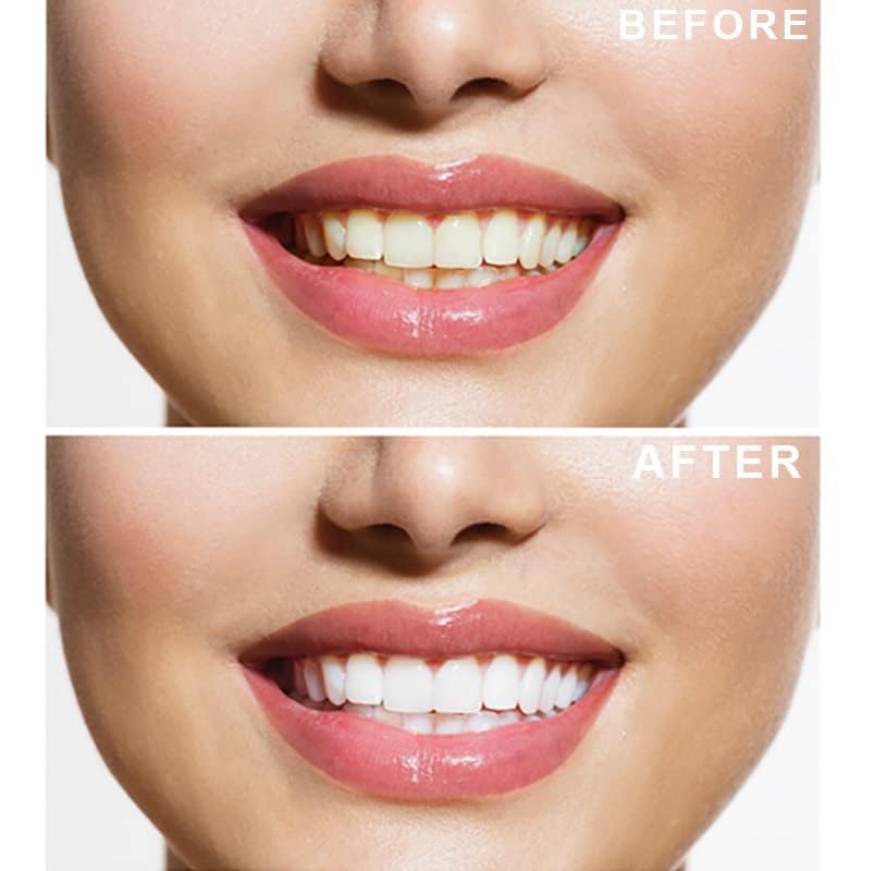 - Teeth Whitening Kit & Whitening Strips | LED Light Activator | 50 Whitening Sessions | 8X3ml Gels | Crystal Strips -