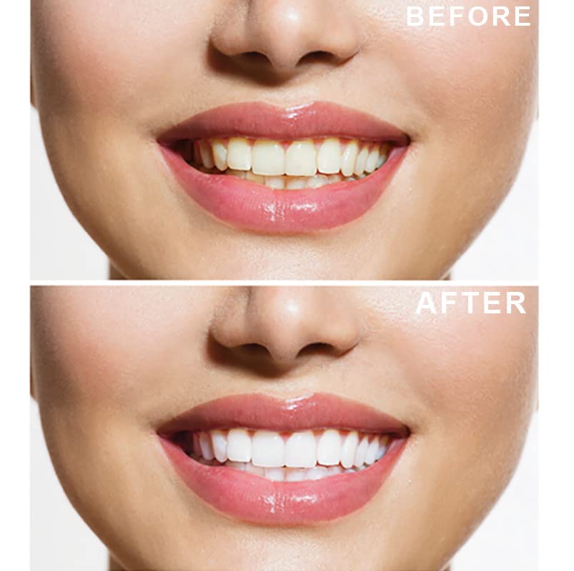 - Teeth Whitening Kit | 6X3ml Whitening Gels with LED Light | Sensitivity Free Formula -