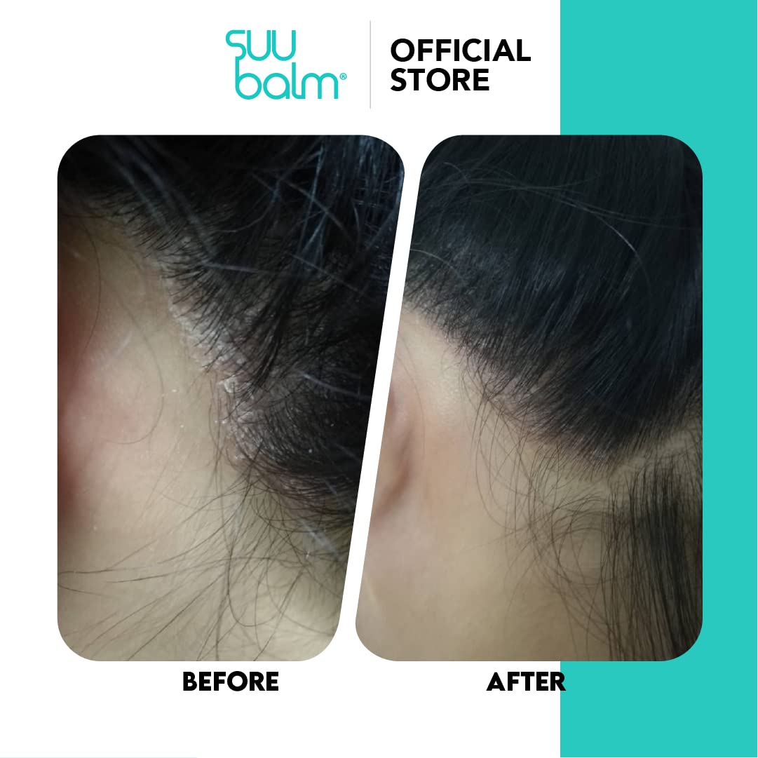 - Suu Balm | Scalp Care Rapid Itch Relief Spray Moisturiser | For Dry, Itchy, Flaky Scalp | 40ml -