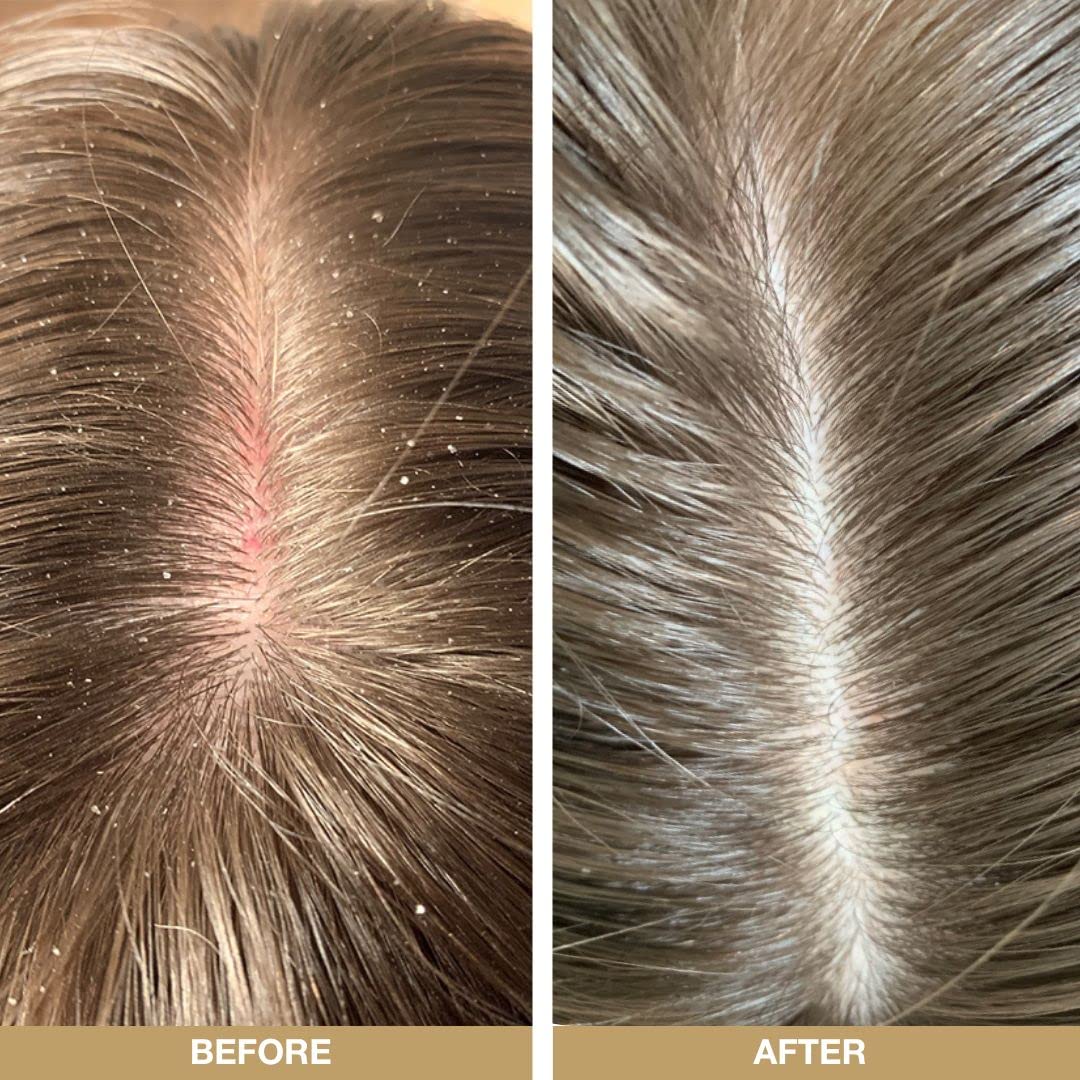 - Scalp Treatment Products from Australian Bodycare for Dry | Itchy | Flaky Scalp & Hair -