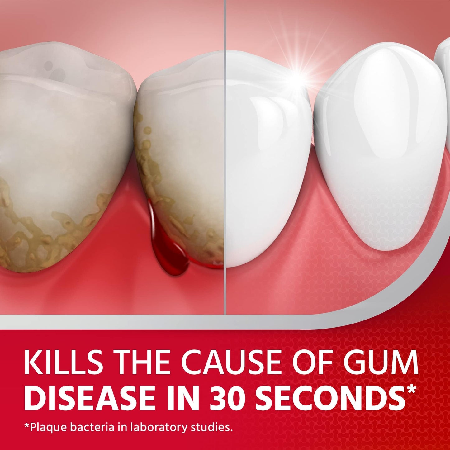 - Prevents gum disease & Bleeding Gum Treatment | Antibacterial Mouthwash -