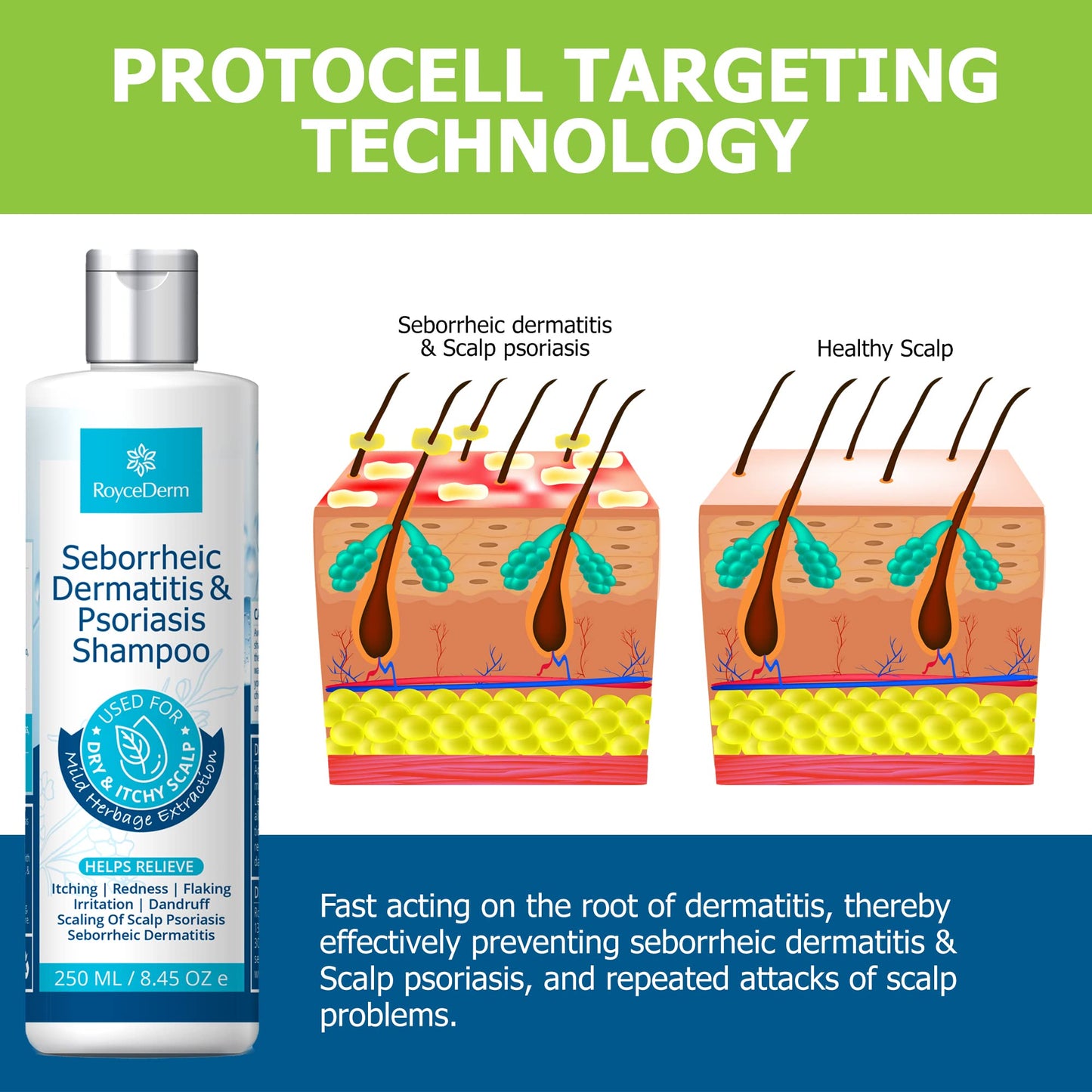 - Roycederm Seborrheic Dermatitis Shampoo | Psoriasis Shampoo | Dandruff Shampoo | Folliculitis Shampoo & Scalp psoriasis Treatment -