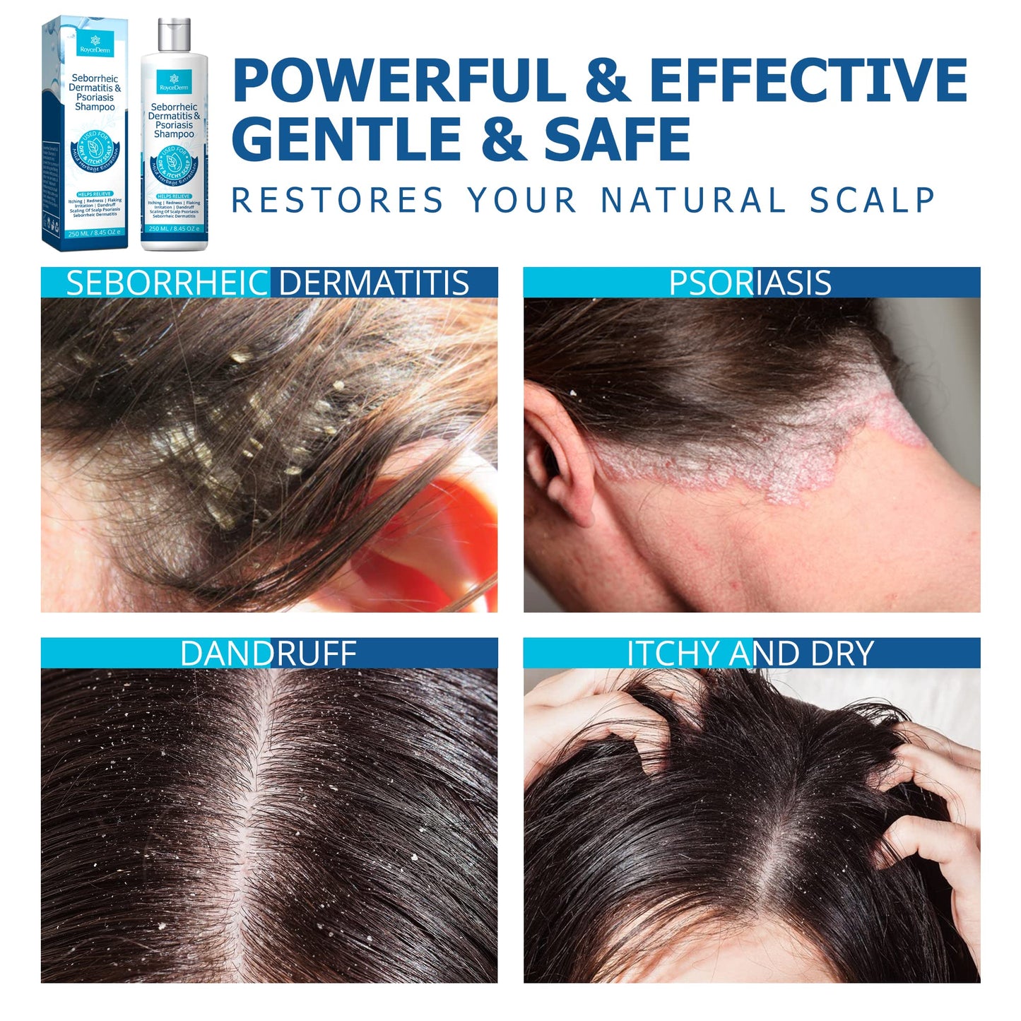 - Roycederm Seborrheic Dermatitis Shampoo | Psoriasis Shampoo | Dandruff Shampoo | Folliculitis Shampoo & Scalp psoriasis Treatment -