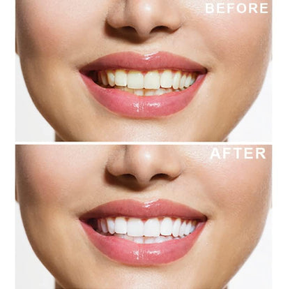 - Teeth Whitening Kit & Whitening Strips | LED Light Activator | 50 Whitening Sessions | 8X3ml Gels | Crystal Strips -