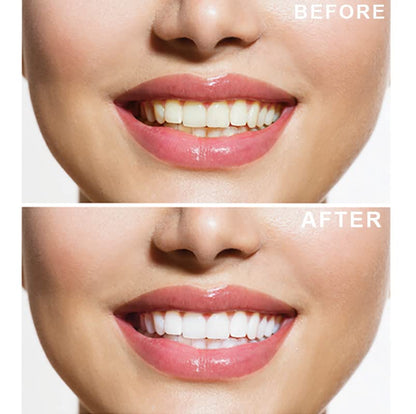 - Teeth Whitening Kit | 6X3ml Whitening Gels with LED Light | Sensitivity Free Formula -